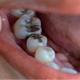 بررسی انواع مواد برای پر کردن دندان‌ها